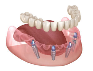 All On 4 Implants In West Palm Beach A Smile Makeover Solution With Fewer Implants