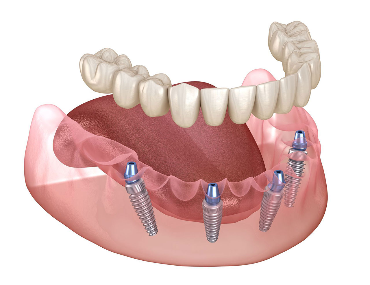 All On 4 Implants In West Palm Beach A Smile Makeover Solution With Fewer Implants