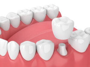 Dental Crowns In West Palm Beach Protecting Damaged Teeth With Natural Looking Strength