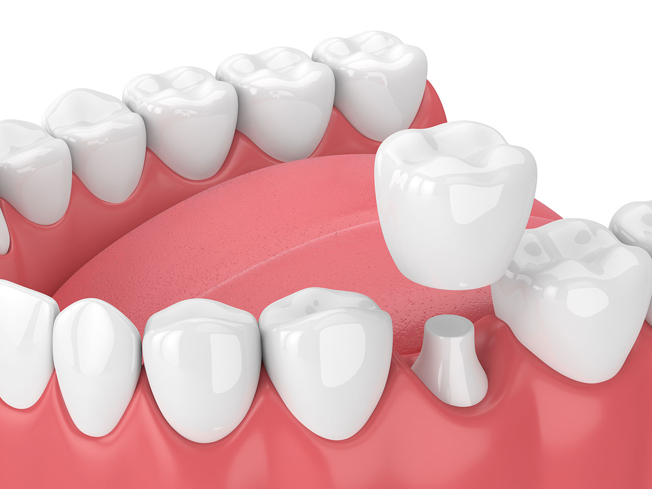 Dental Crowns In West Palm Beach Protecting Damaged Teeth With Natural Looking Strength