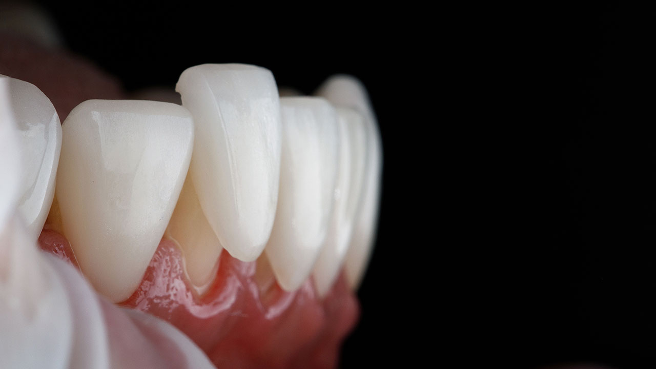 Porcelain Veneers In West Palm Beach A Natural Looking Way To Refine Your Smile