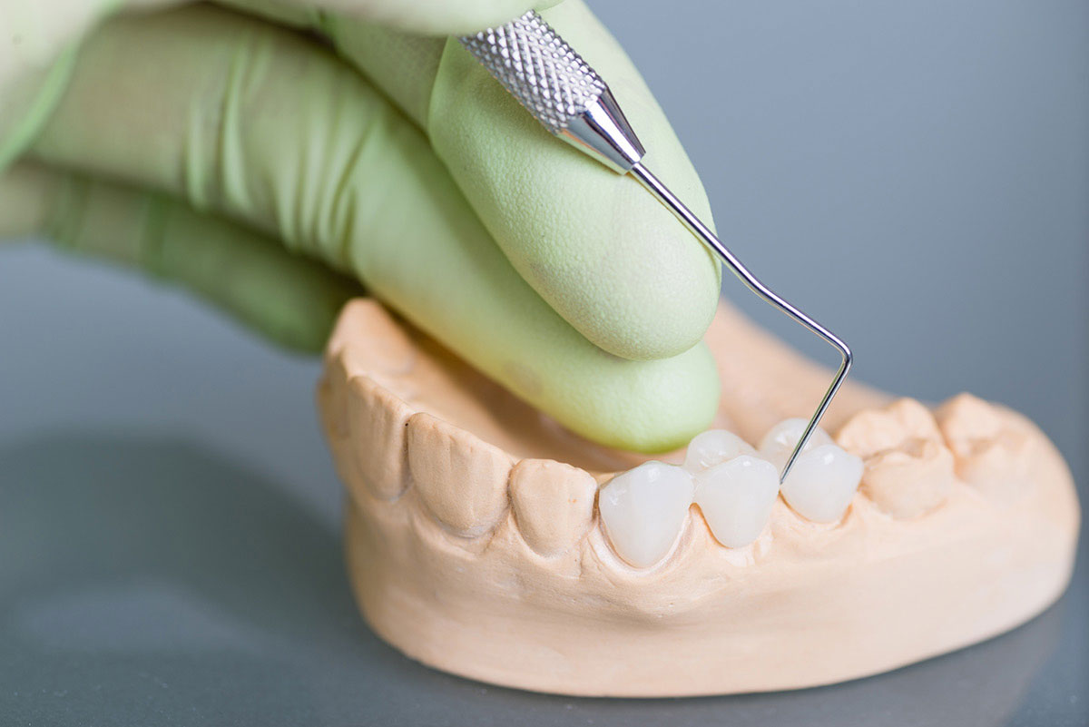 WPB Dental & Implants | Dental Bridges in West Palm Beach: Replacing Missing Teeth With Comfortable Support